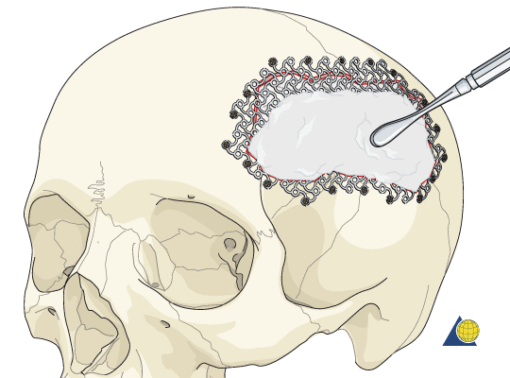 Craneoplastic | Productos Medicos para Craneoplatias