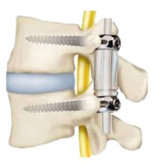 Productos y Servicios Medicos para Cirugia de Columna Lumbar en Guadalajara