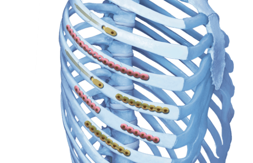 Placas para fijación y estabilización de fracturas en las costillas en cirugias de trauma | IGEA