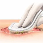 apósitos para heridas | Soluciones medico quirurgicas en mexico | IGEA