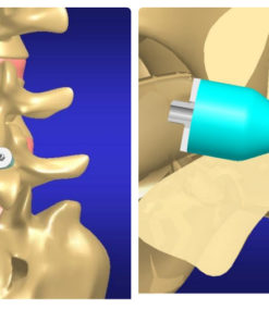 Tornillos de Titanio en Guadalajara | Productos y Servicios Medicos en Guadalajara