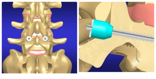 Tornillos de Titanio en Guadalajara | Productos y Servicios Medicos en Guadalajara