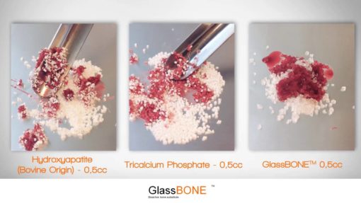 GlassBONE | Productos Medicos para Injertos en Guadalajara | IGEA