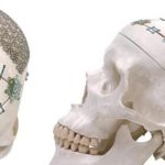 MINI PLACA | Productos y Servicios Medicos en Guadalajara para Cirugias de Neurologia | IGEA