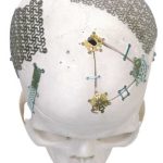 Mini Placa | Productos Medicos para Cirugias de Neuro | IGEA