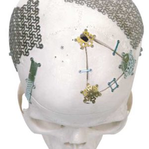 Mini Placa | Productos Medicos para Cirugias de Neuro | IGEA