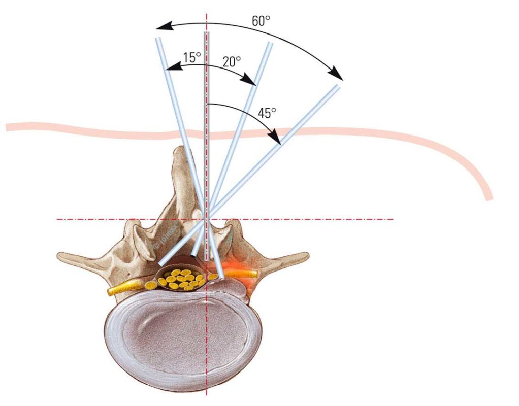 acceso interlaminar endoscópico Joimax | IGEA