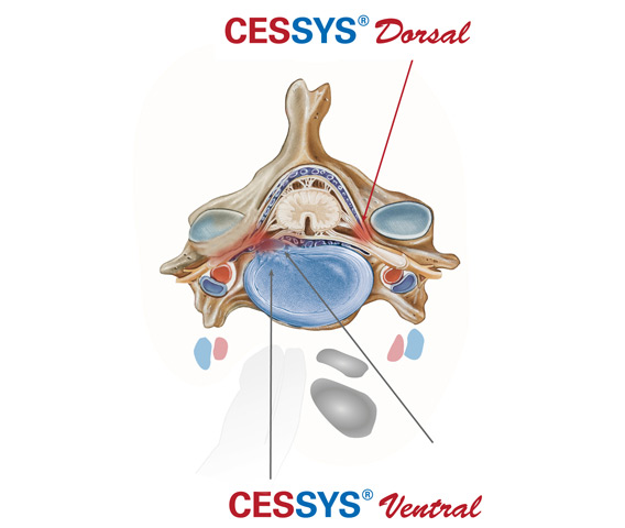 cirugia endoscopica de columna cervical | Joimax