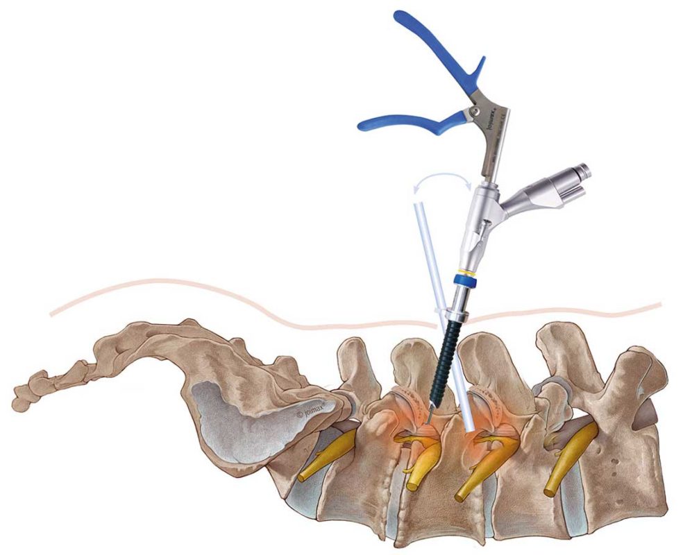 cirugia endoscopica de columna con ILESSYS | Joimax