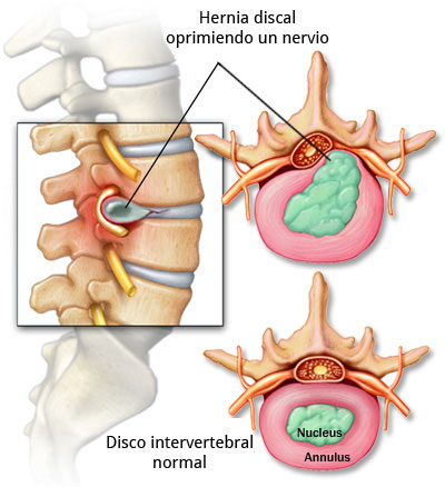 cirugia endoscopica lumbar para hernia discal | IGEA