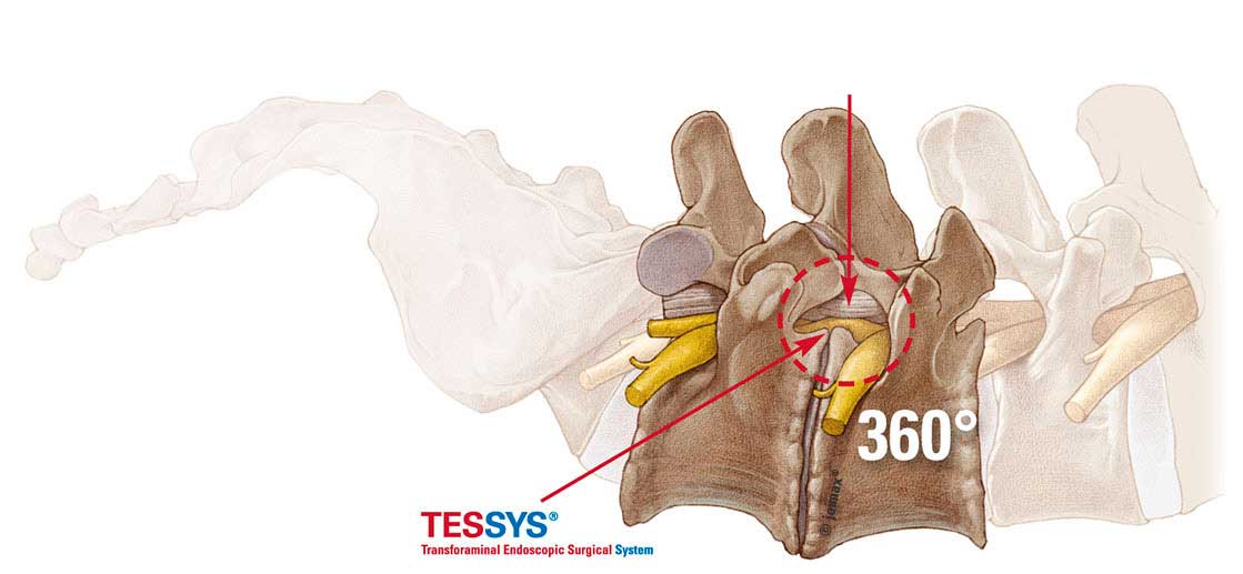 cirugia lumbar co endoscopia | Joimax