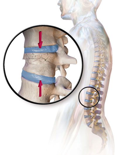 en que pacientes se puede aplicar la cirugia endoscopica de columna | IGEA