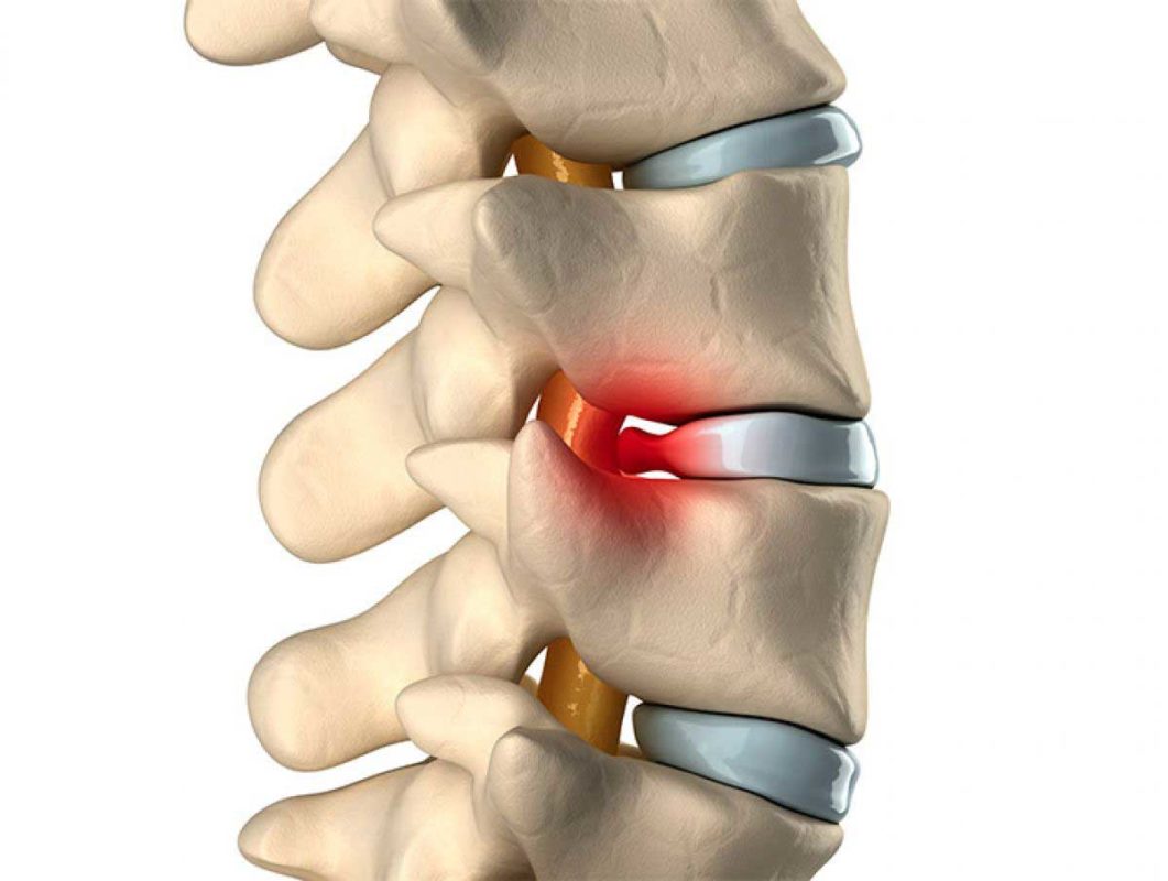 hernia de disco en columna | IGEA