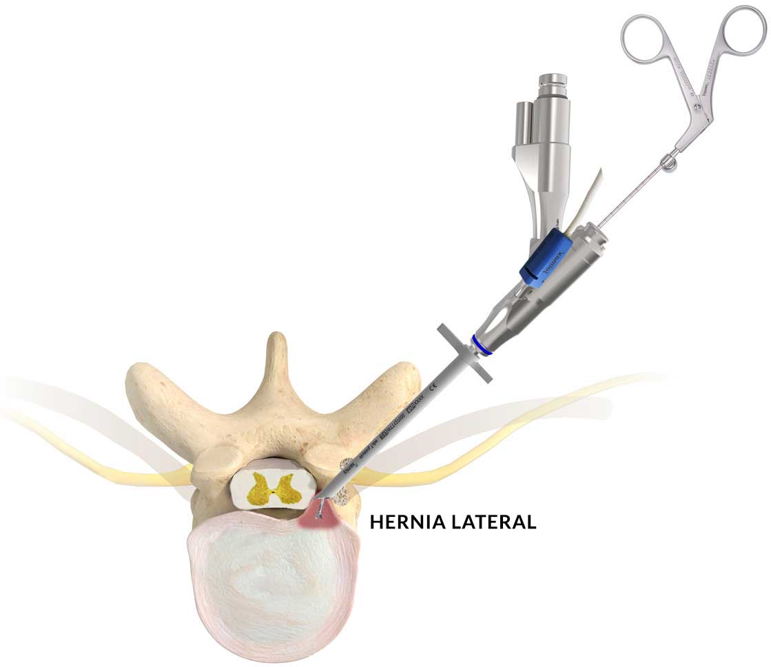ventajas de la cirugia endoscopica lumbar con Joimax