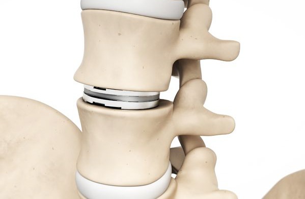 Cirugía de implantación de disco cervical artificial | equipos medicos para cirugias de columna en guadalajara | IGEA