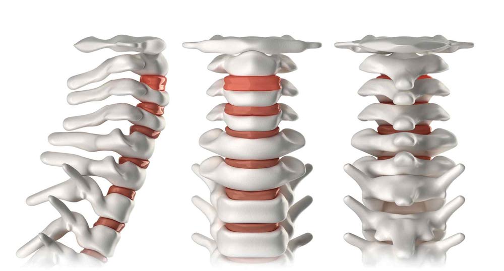 Síntomas de una Hernia Cervical | IGEA