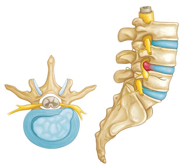 sintomas de hernia discal lumbar | IGEA