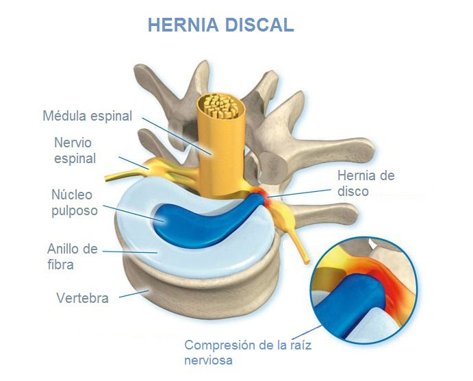 sintomas de hernia toracica o dorsal |IGEA