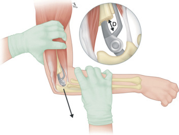 artoplastia de codo | cirugia de trauma y ortopedia en guadalajara