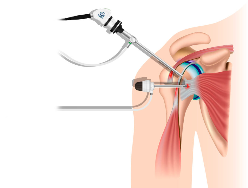 tipos de cirugia de hombro | Trauma y Ortopedia en Guadalajara