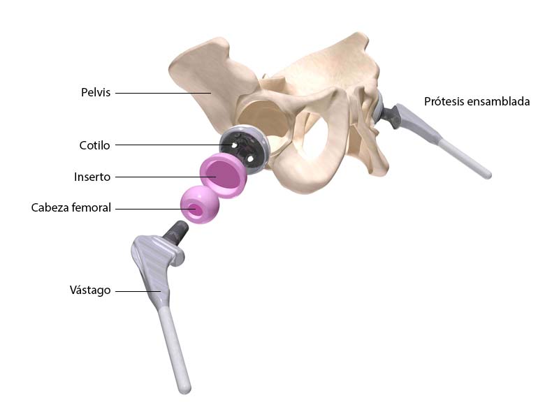 cirugia de protesis de cadera en Guadalajara | IGEA