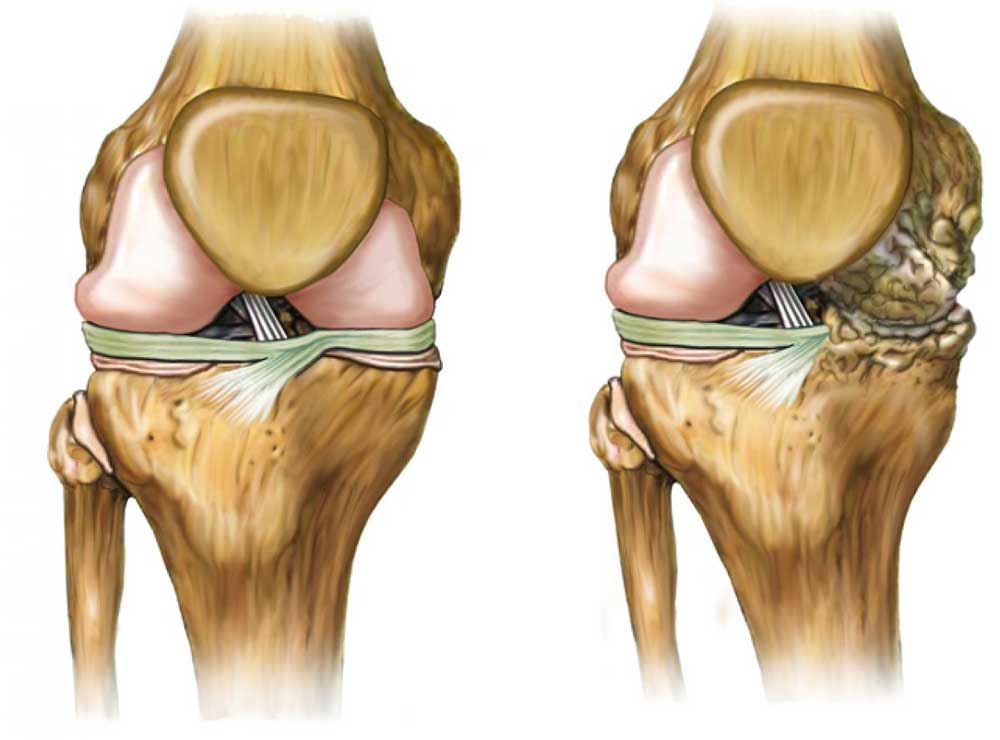 cirugia de rodilla | Cirugias de trauma y ortopedia | IGEA