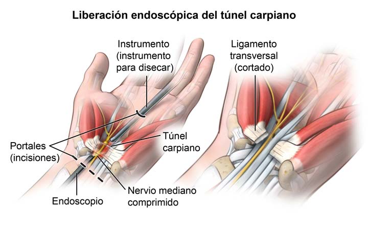 cirugia del tunel carpiano | cirugia de trauma y ortopedia en guadalajara