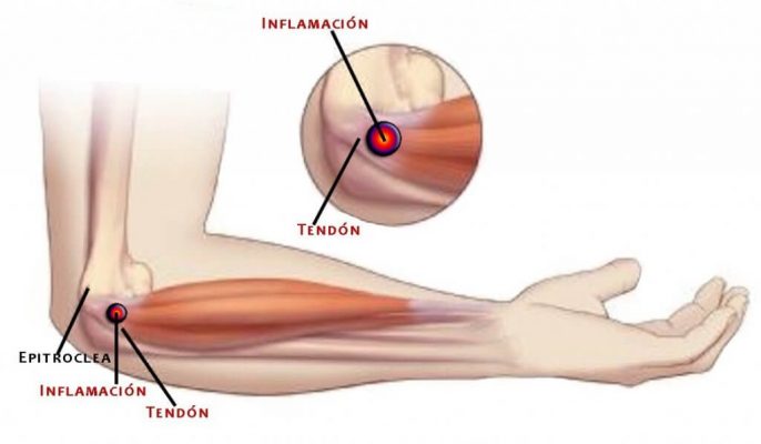 que es una cirugia de codo | servicios medicos en trauma y ortopedia en guadalajara