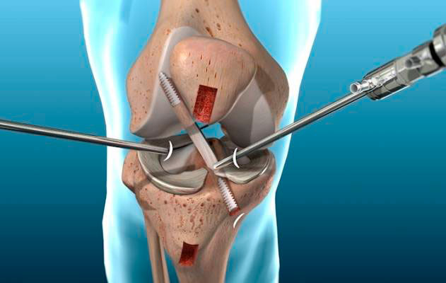 Equipos Medicos para Artroscopia | Artroscopia de Rodilla