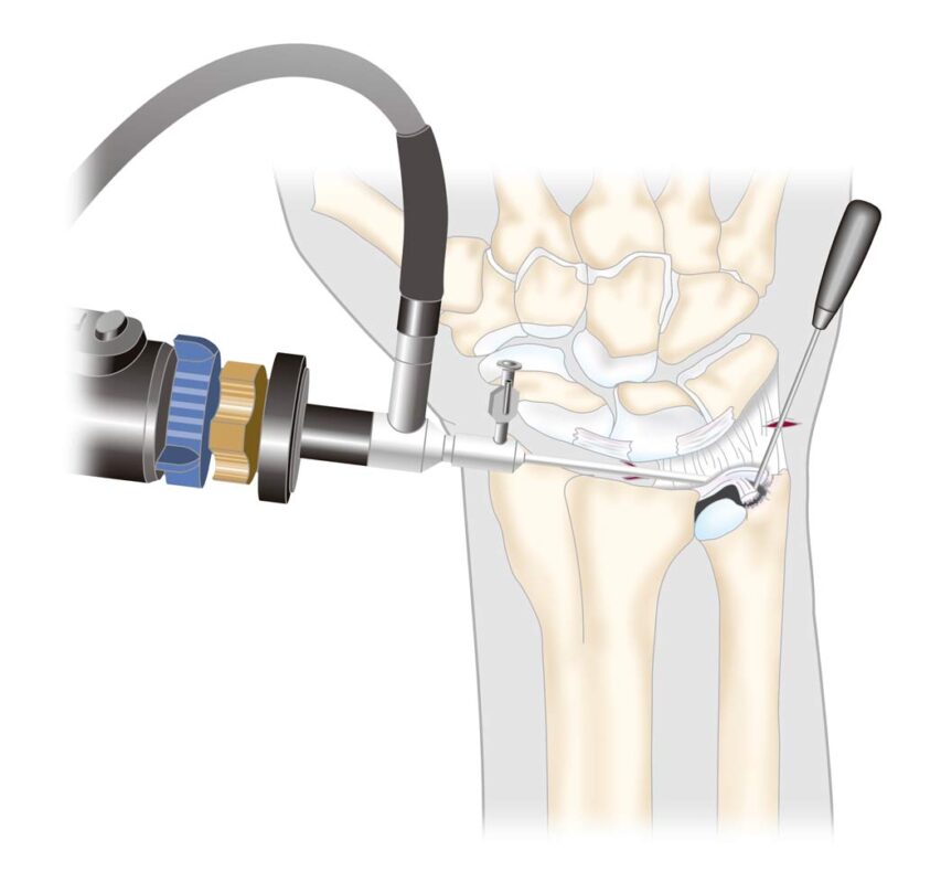 Ventajas de la Cirugía Artroscópica | artroscopia de muñeca