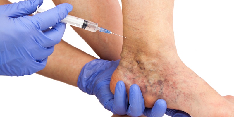 que tipo de varices requieren cirugia | red de medicos especialistas en Guadalajara | IGEA