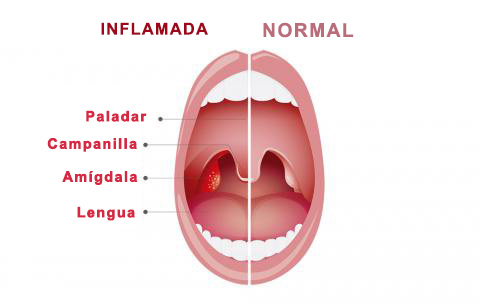 En Qué Consiste la Cirugia de Amígdalas | IGEA