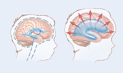 Hidrocefalia |Qué es la Hidrocefalia | Cirugia de Neuro | IGEA