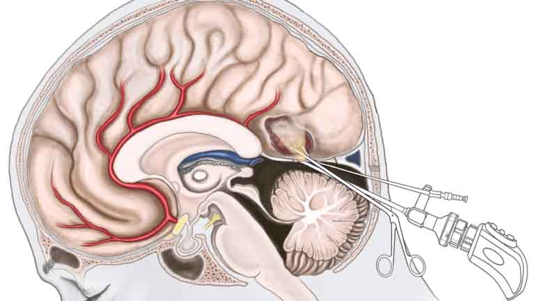 Qué es la Resección de Tumor Cerebral | Renta y Venta de Equipos Medicos para Cirugia en Guadalajara 1 IGEA