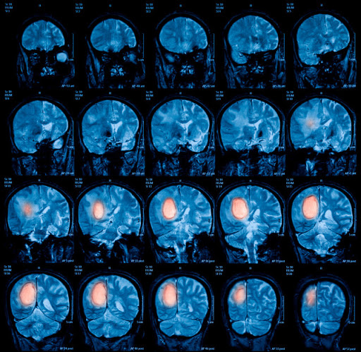 Tipos de Tumores Cerebrales | Renta de equipos para Neurocirugia | IGEA