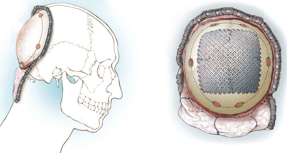 tipos de reconstruccion de craneo | IGEA