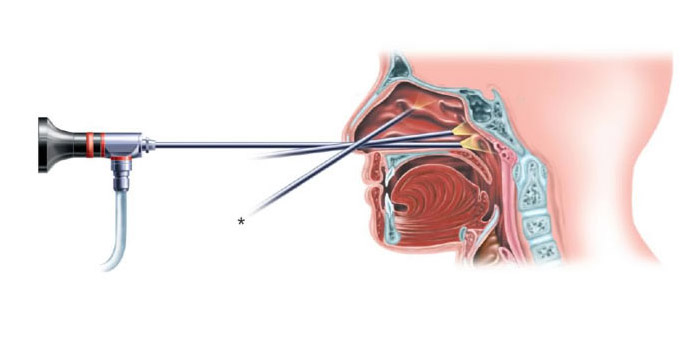 Ventajas de la Cirugia Endoscopica de Otorrino | Equipos Medicos en Guadalajara | IGEA