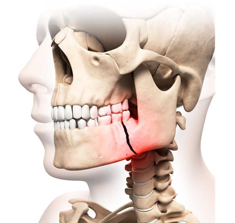 Cuándo Puede Ser Necesaria una Cirugía de Traumatología Maxilofacial | Cirugia de Trauma | IGEA Guadalajara