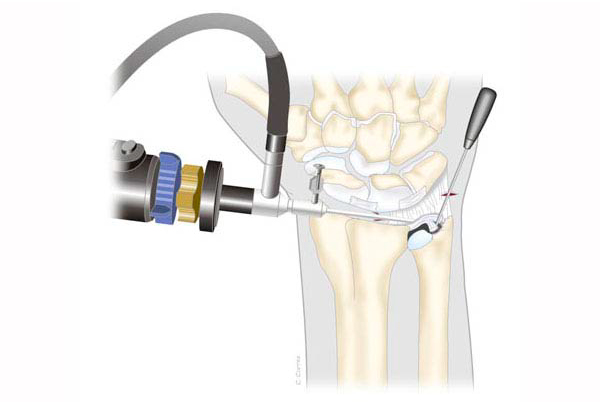 Tipos de Cirugía en la Mano | artroscopia de muñeca en Guadalajara, MOnterrey, Cancu, los Cabos y Ciudad de Mexico