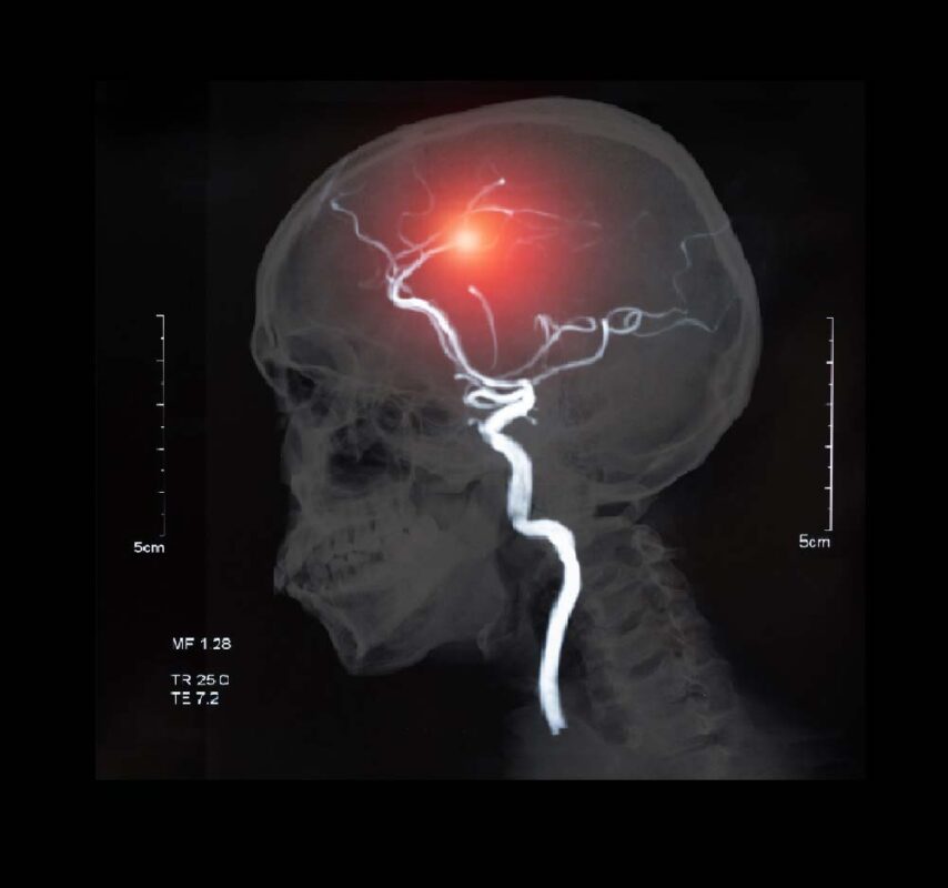 Qué Puede Causar un Accidente Cerebral Hemorrágico | IGEA México