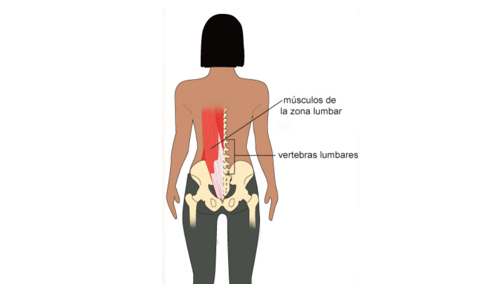 Tipos de lumbalgia | IGEA México