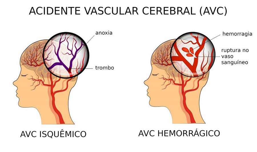 tipos de derrames cerebrales | productos y servicios medicos en guadalajara, mexico, monterrey, los cabos y cancun