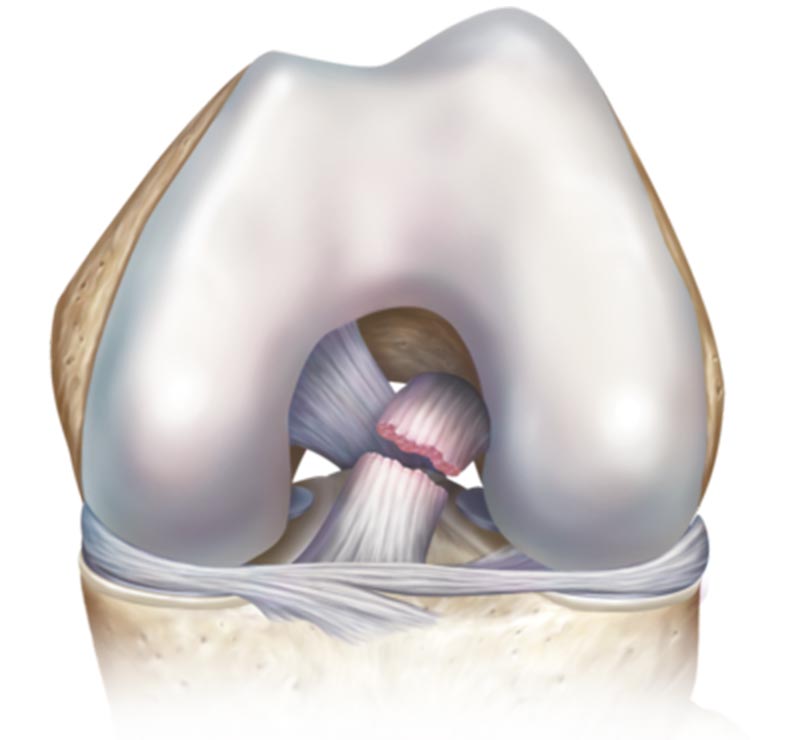 ruptura del ligamento cruzado anterior | lesión del ligamento cruzado anterior de la rodilla México, Monterrey, Guadalajara, Cancun y los Cabos