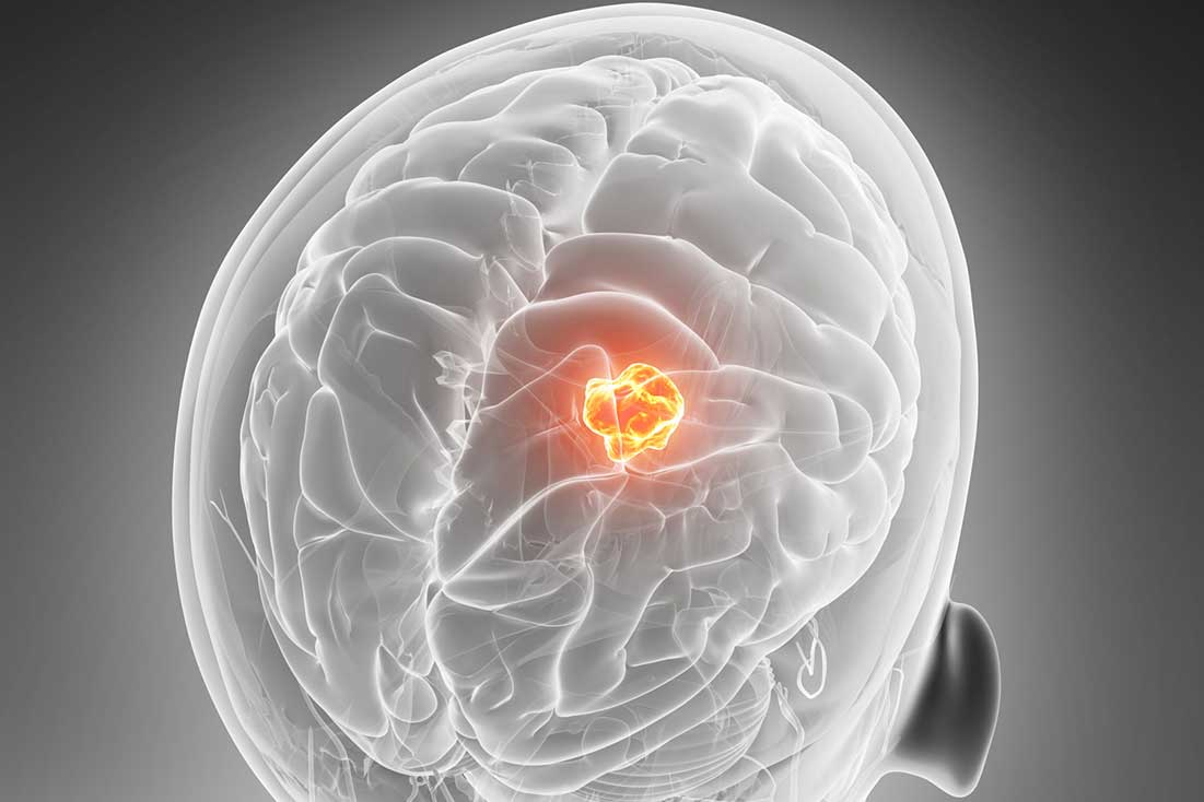 tumor cerebral | equipos y servicios medicios paraneurocirugia en Mexico, Guadalajara, Los Cabos, Monterrey y Cancun | IGEA