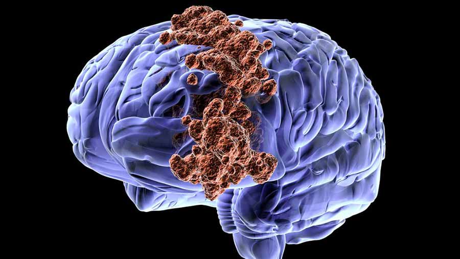 tumor en el cerebro | equipos y servicios medicios paraneurocirugia en Mexico, Guadalajara, Los Cabos, Monterrey y Cancun | IGEA