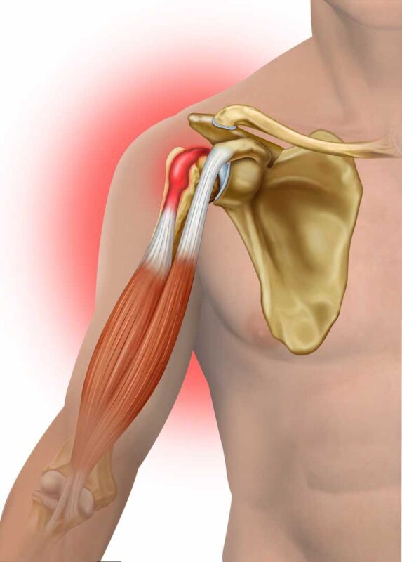 Qué Tipos de Tendinitis Son Más Comunes | Renta y Venta de Equipos Médicos en Guadalajara, Monterrey, Cancun y los Cabos