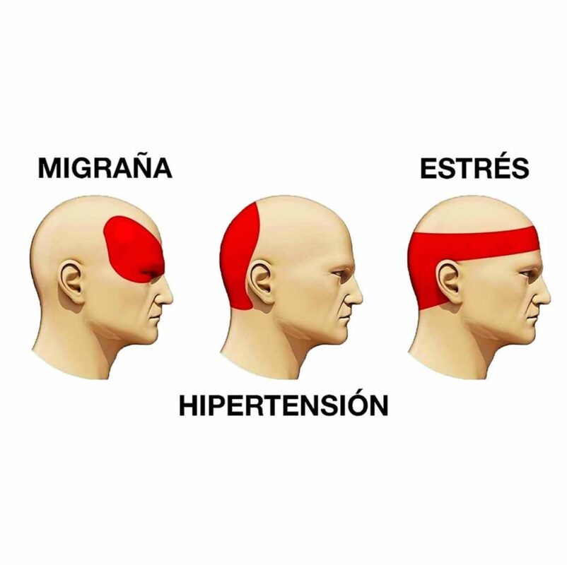 dolor de cabeza por migrañas, estres e hipertensión | tipos de cefaleas | IGEA Guadalajara Mexico