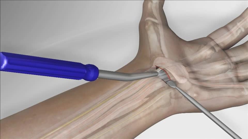 Cómo se hace la Cirugía del túnel Carpiano en Guadalajara Mexico