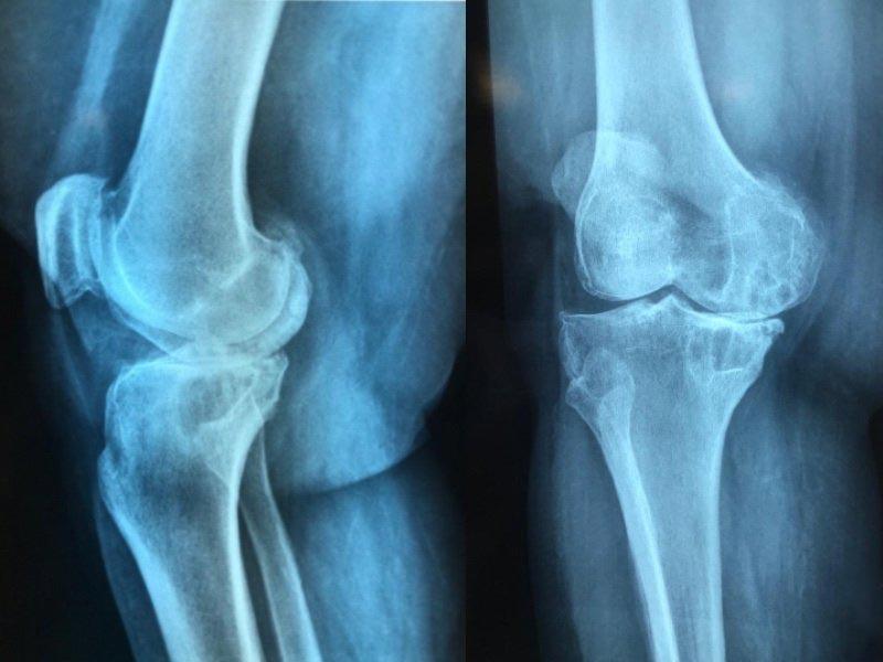 que es la osteoartritis | tratamientos para la osteoartritis en mexico, guadalajara, cancun, monterrey y los cabos | IGEA