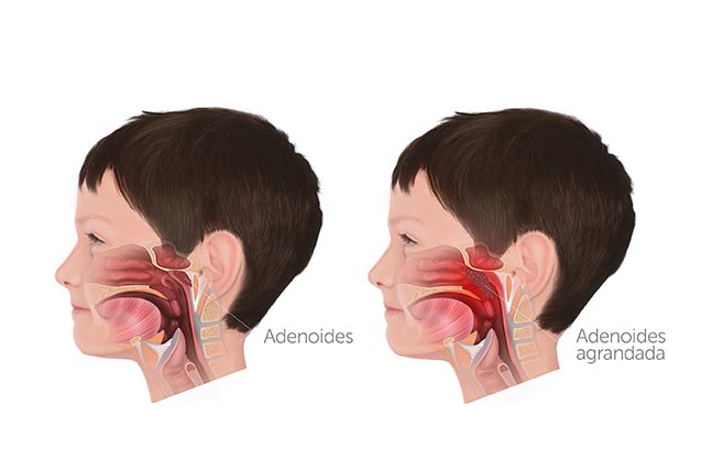 Cómo Saber si un Niño tiene Adenoides | cirugia pediatrica en guadalajara | IGEA Mexico